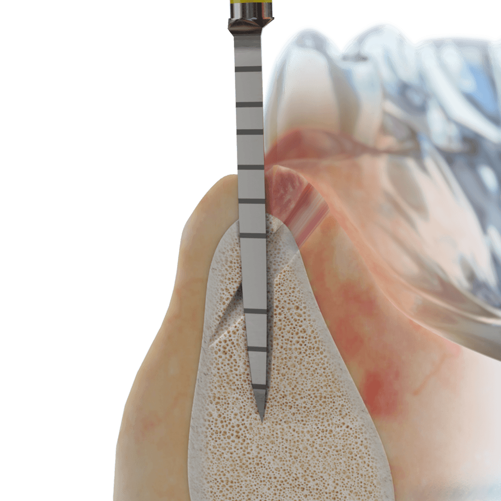 Cortical Navigated Implant Procedure