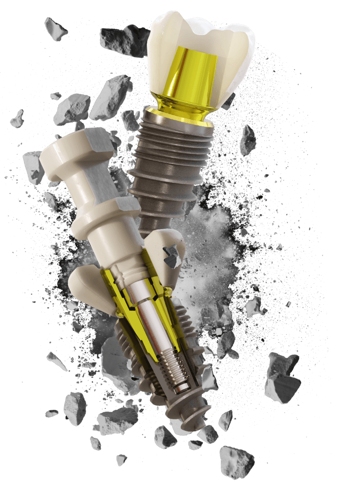 L'implant Champions (R)Evolution