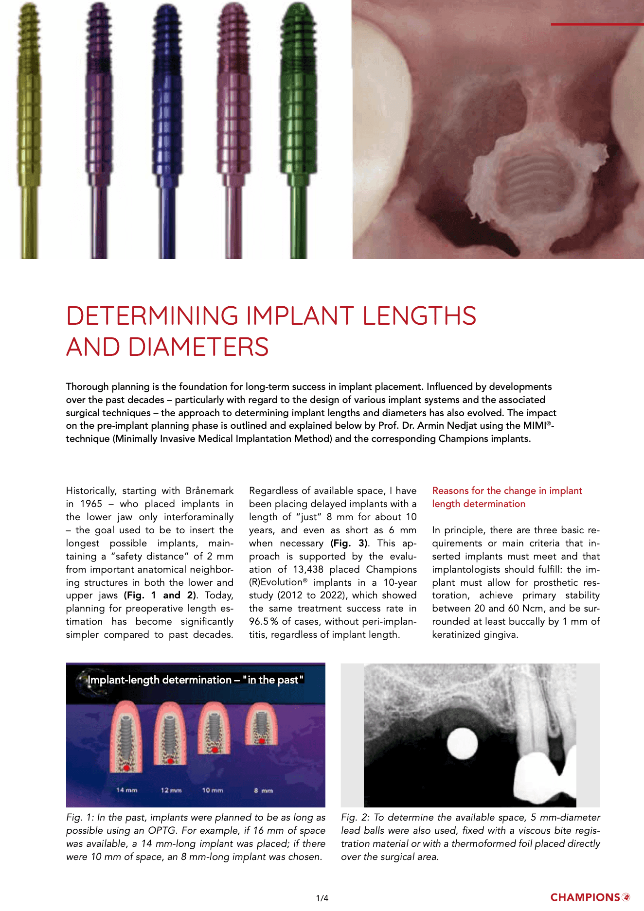 Determining implant lengths and diameters