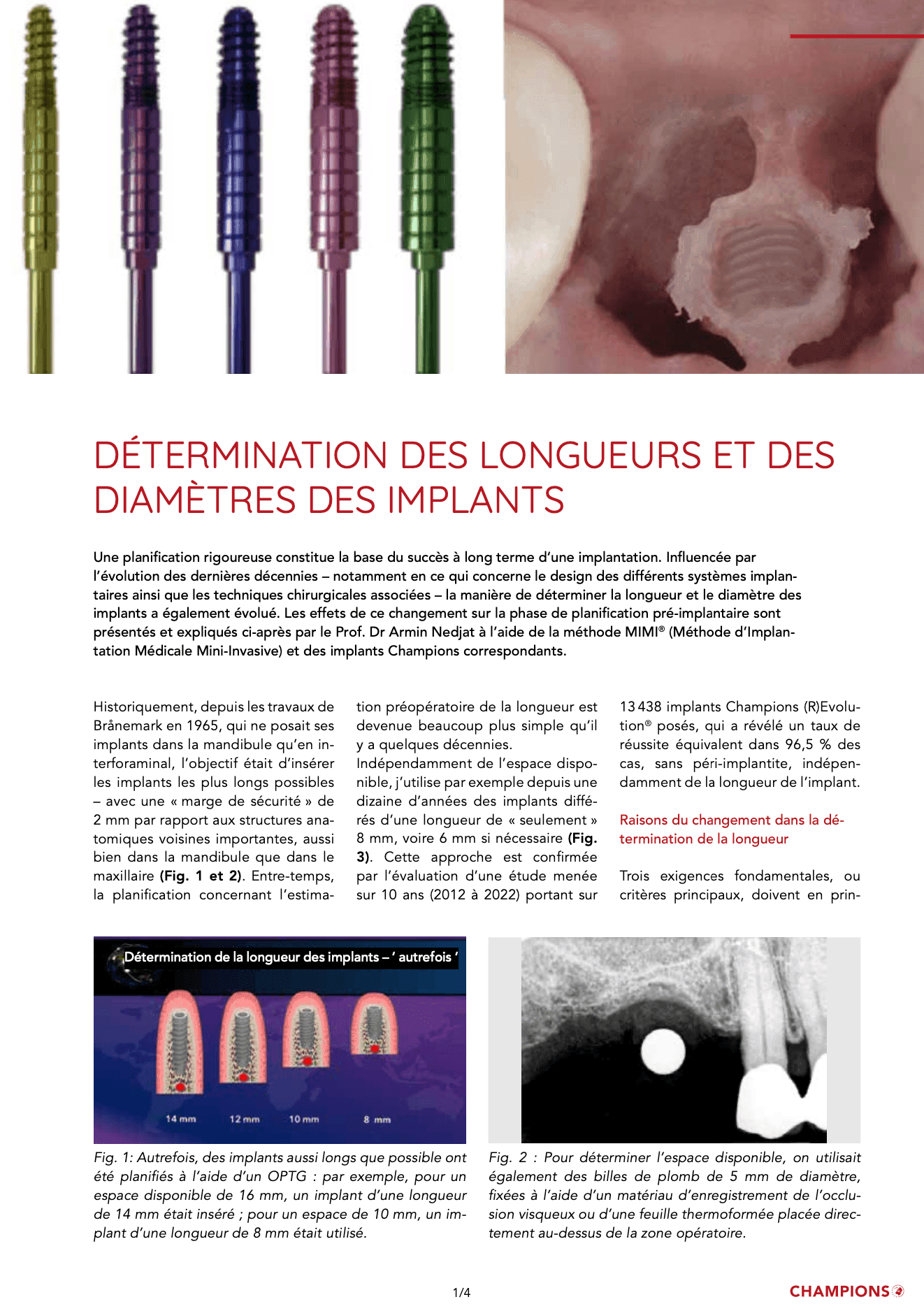Détermination des longueurs et des diamètres des implants