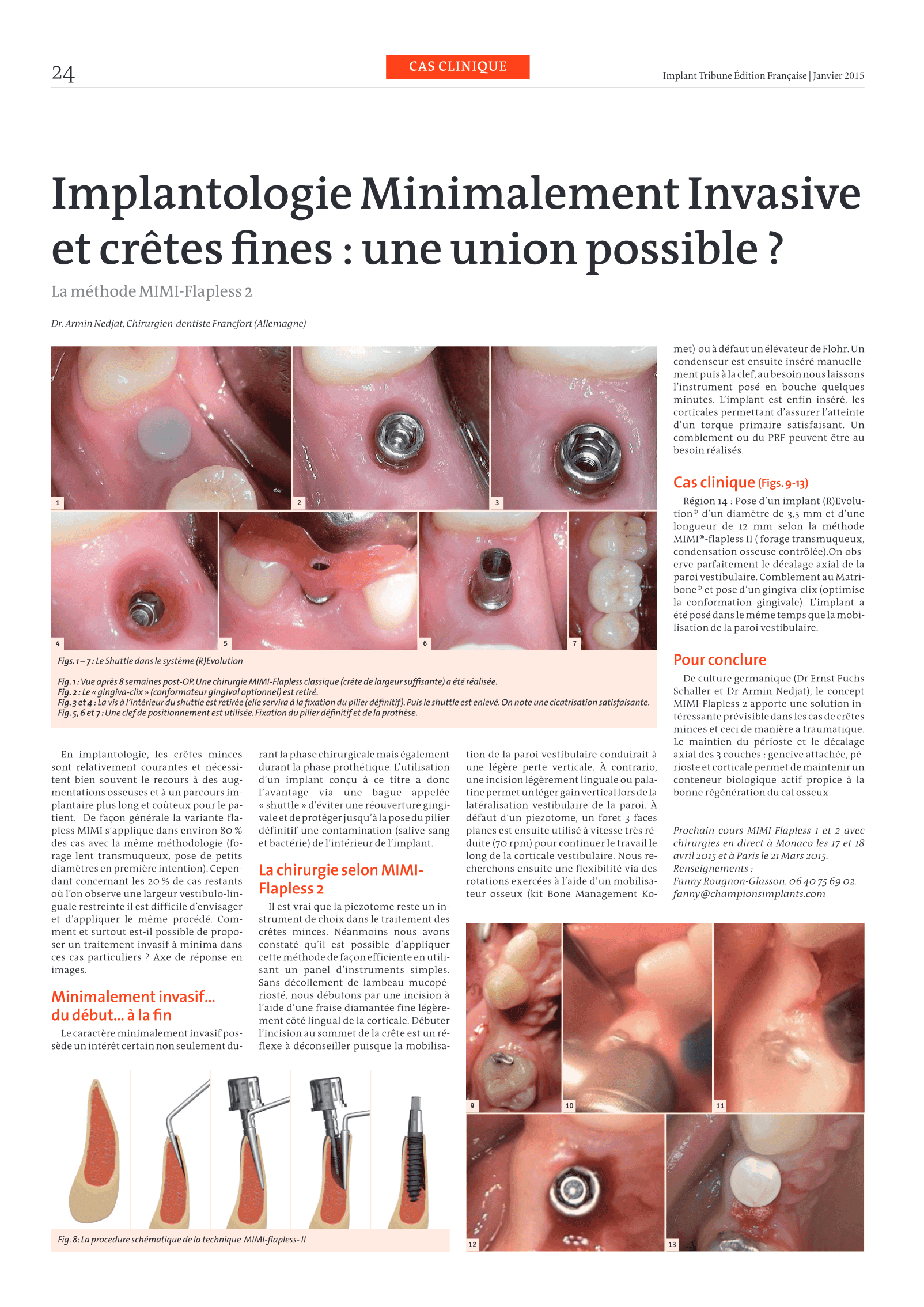 Implantologie Minimalement Invasive
et crêtes fines: une union possible?