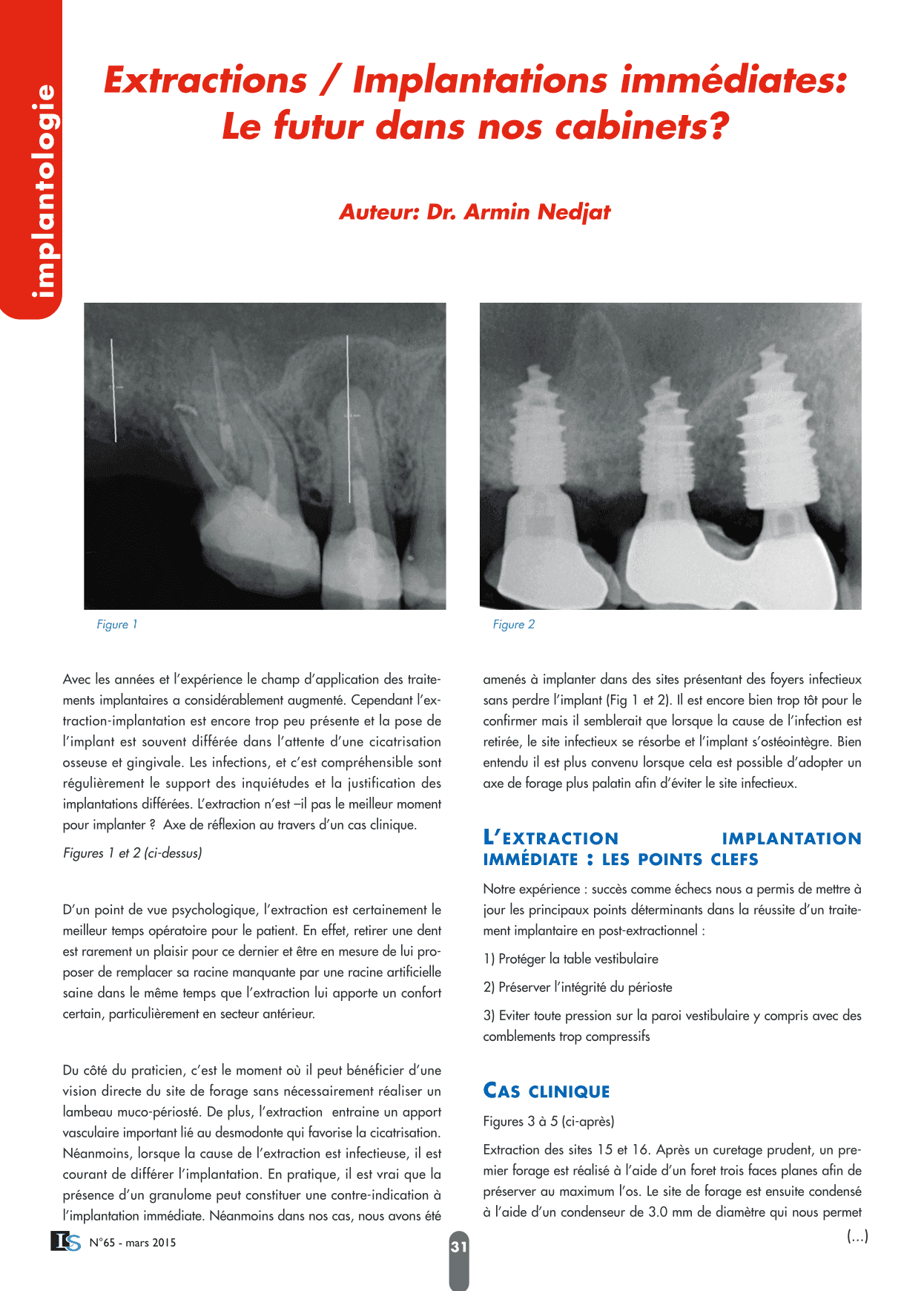 Extractions / Implantations immédiates:
Le futur dans nos cabinets?