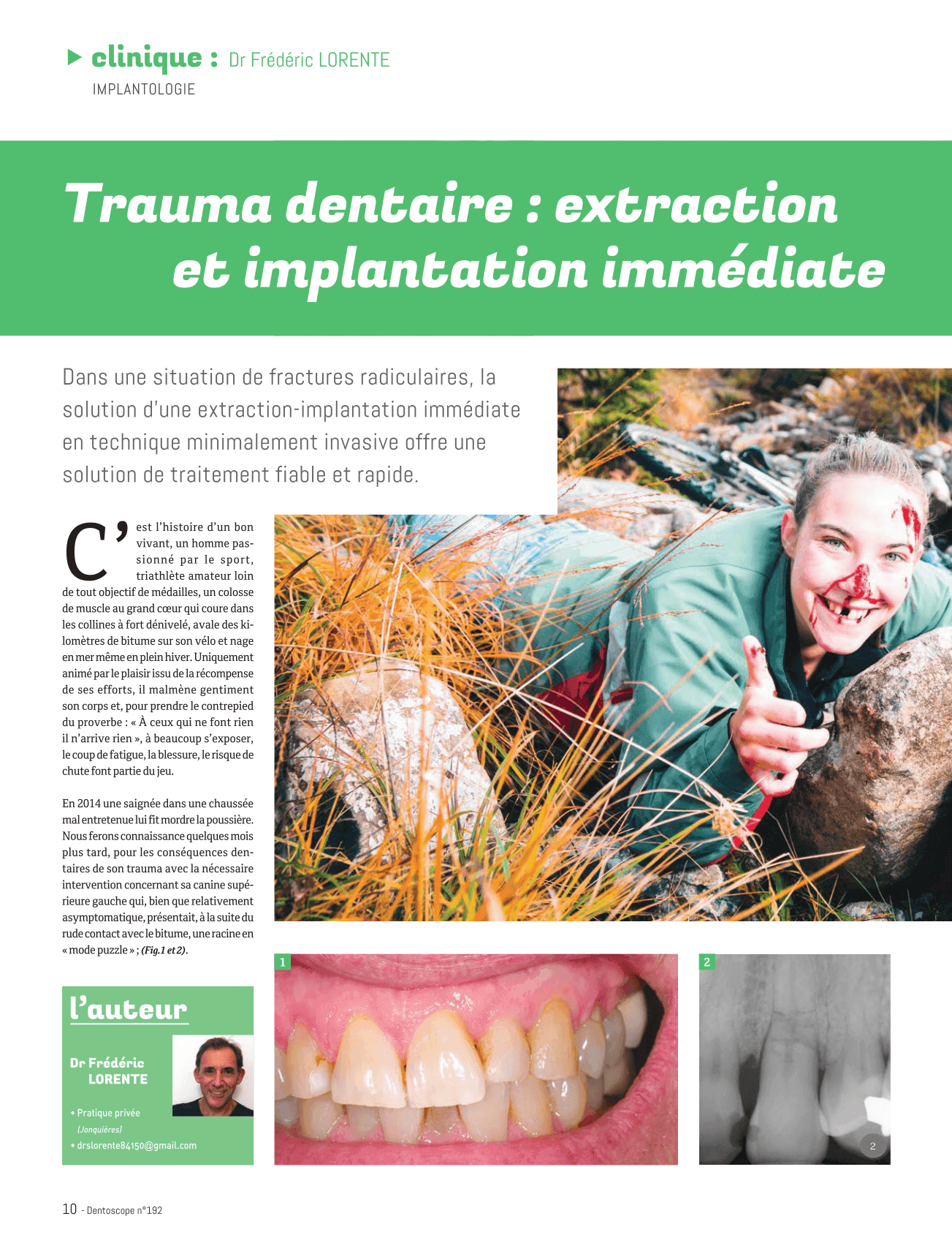Trauma dentaire : extraction et implantation immédiate