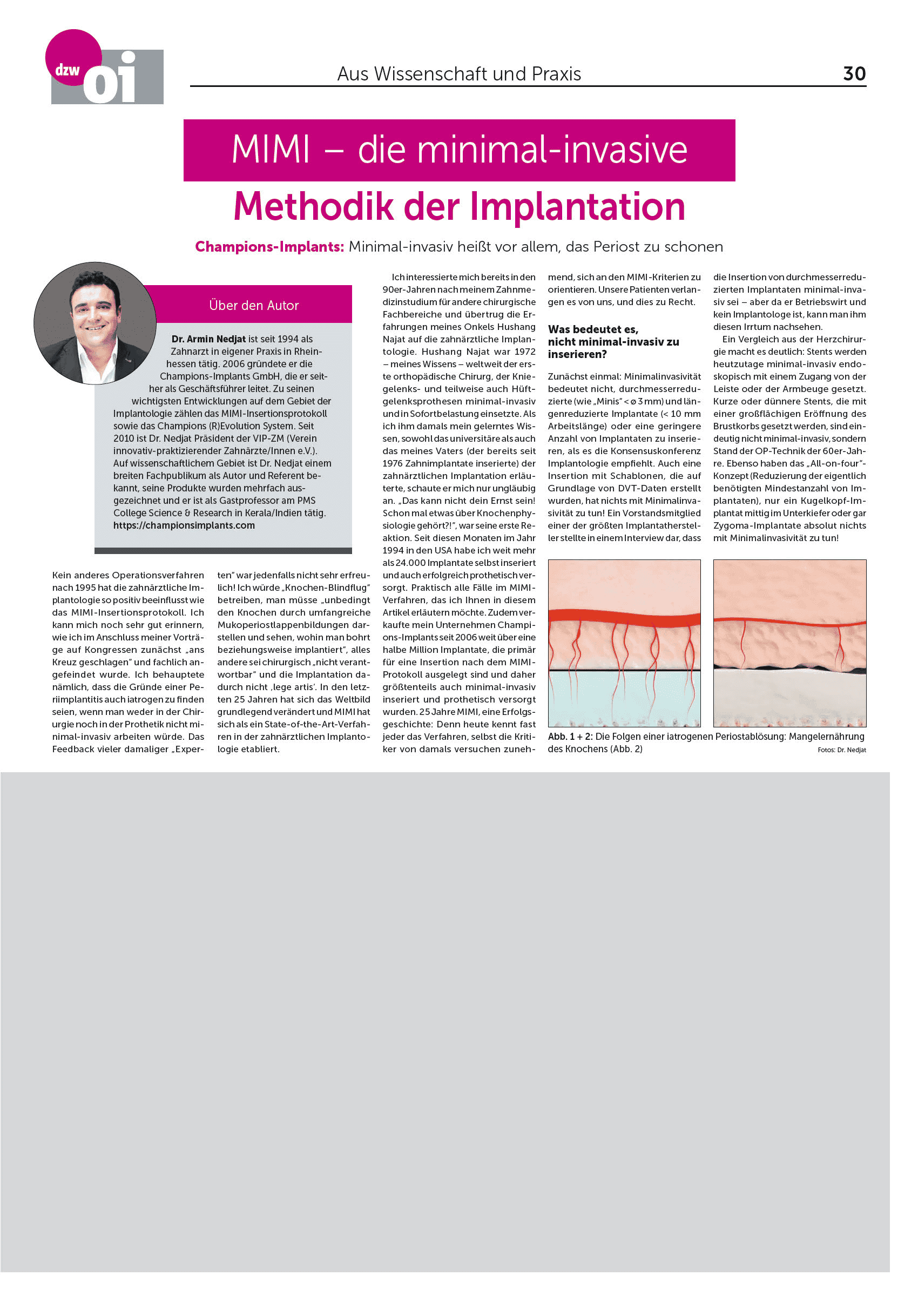 MIMI - die minimal-invasive Methodik der Implantation