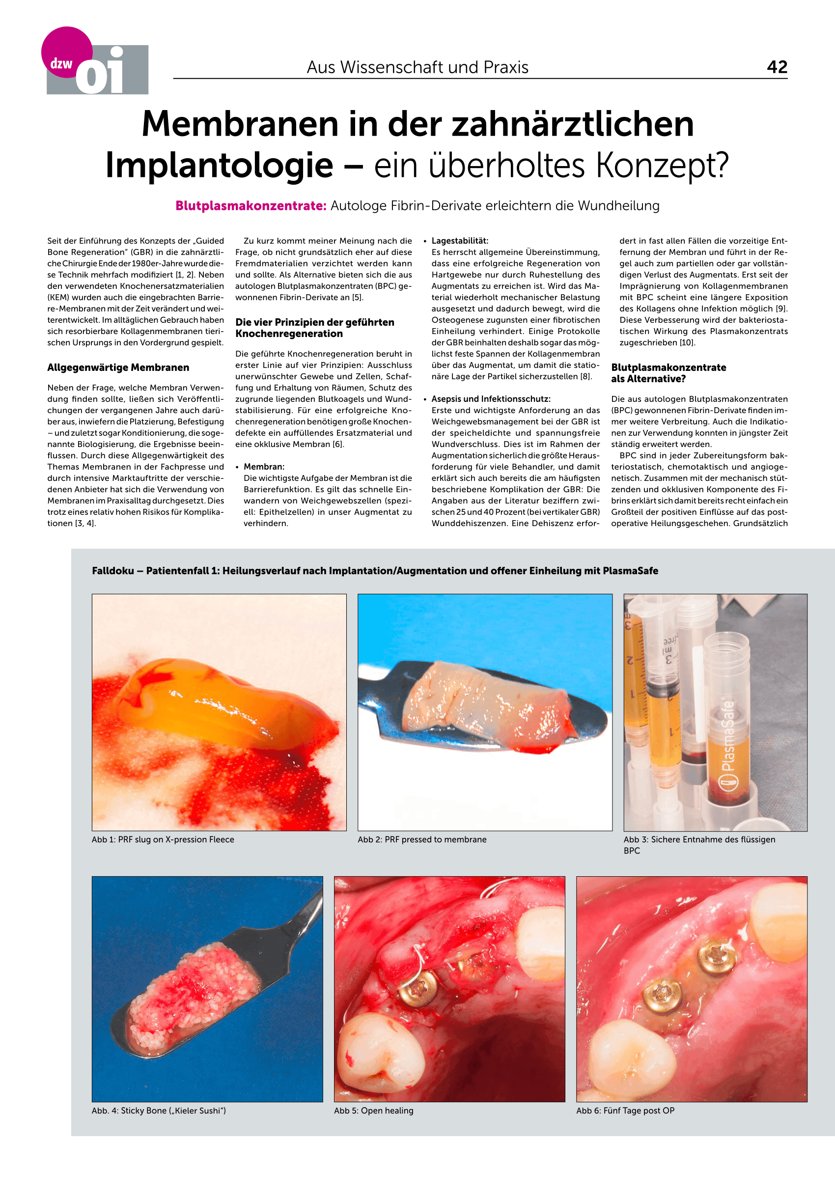 Blutplasmakonzentrate: Autologe Fibrin-Derivate erleichtern die Wundheilung