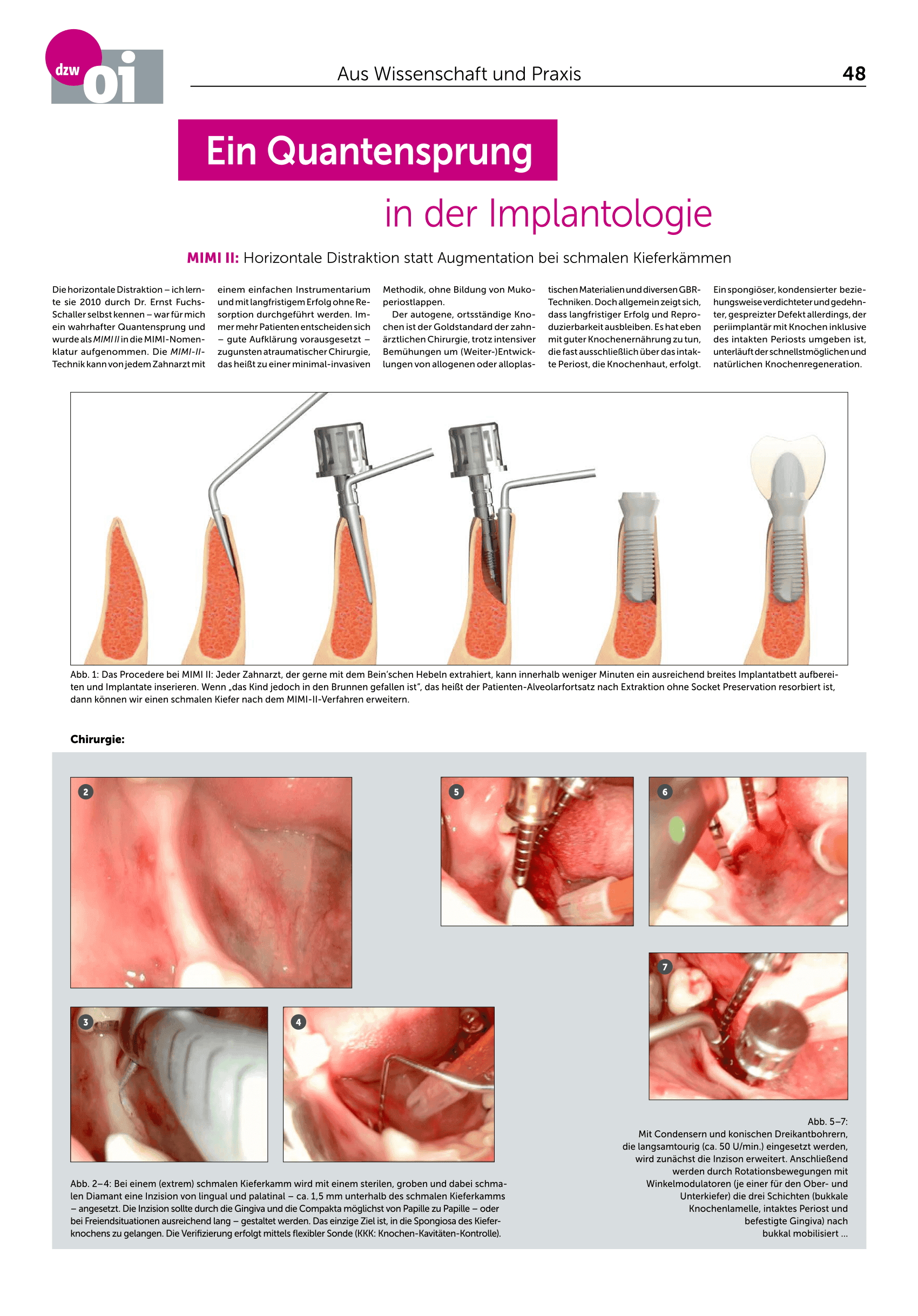 MIMI II: Horizontale Distraktion statt Augmentation bei schmalen Kieferkämmen