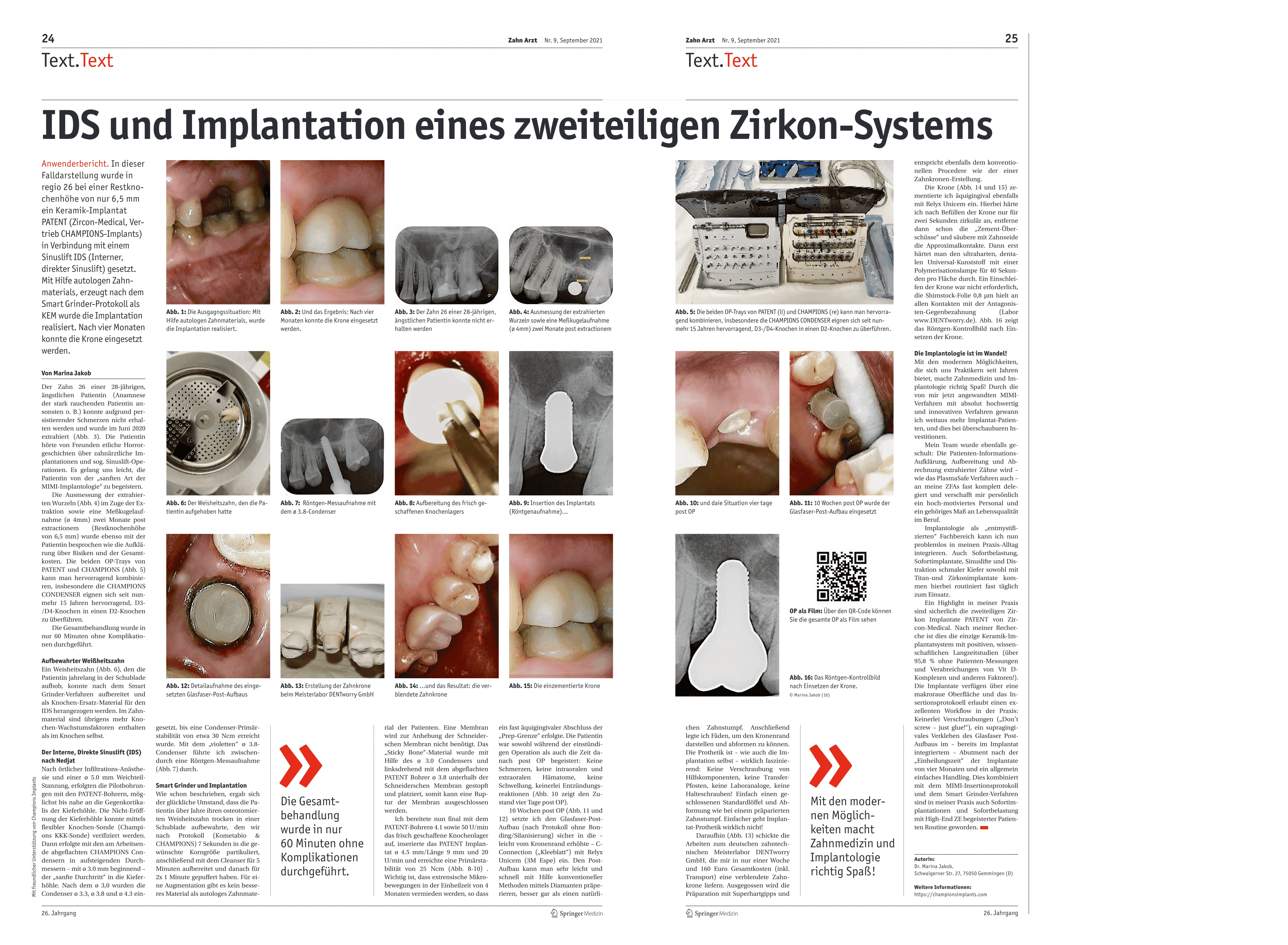IDS und Implantation eines zweiteiligen Zirkon-Systems