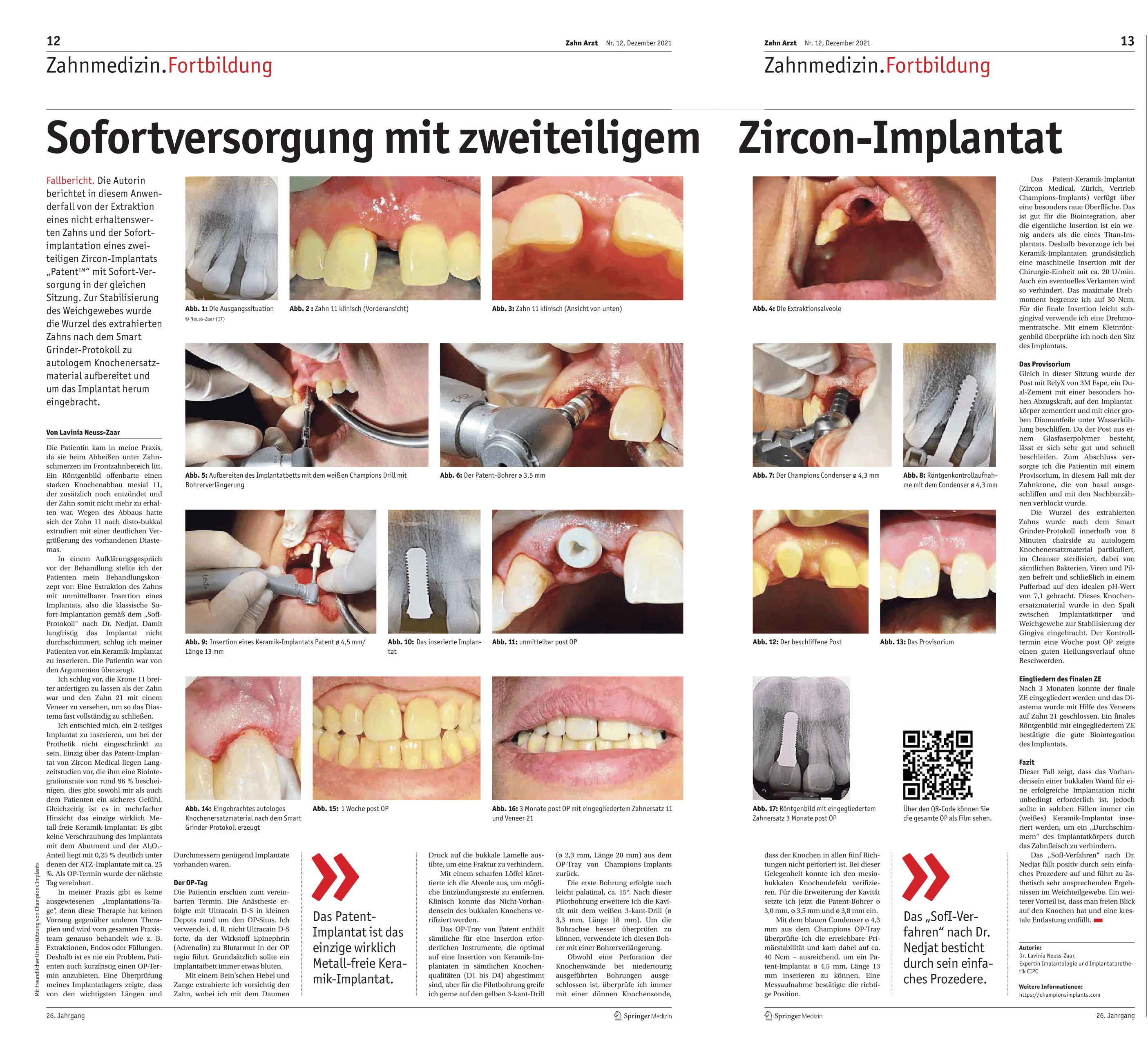 Sofortversorgung mit zweiteiligem Zircon-Implantat