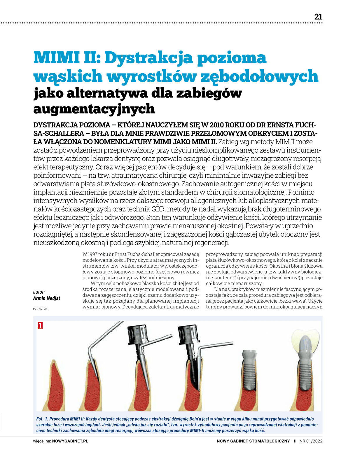 MIMI II: Dystrakcja pozioma
wąskich wyrostków zębodołowych