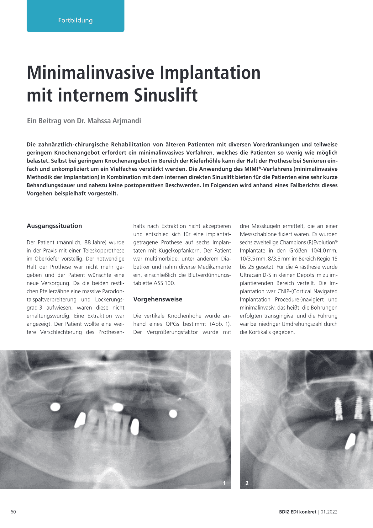 Minimalinvasive Implantation
mit internem Sinuslift