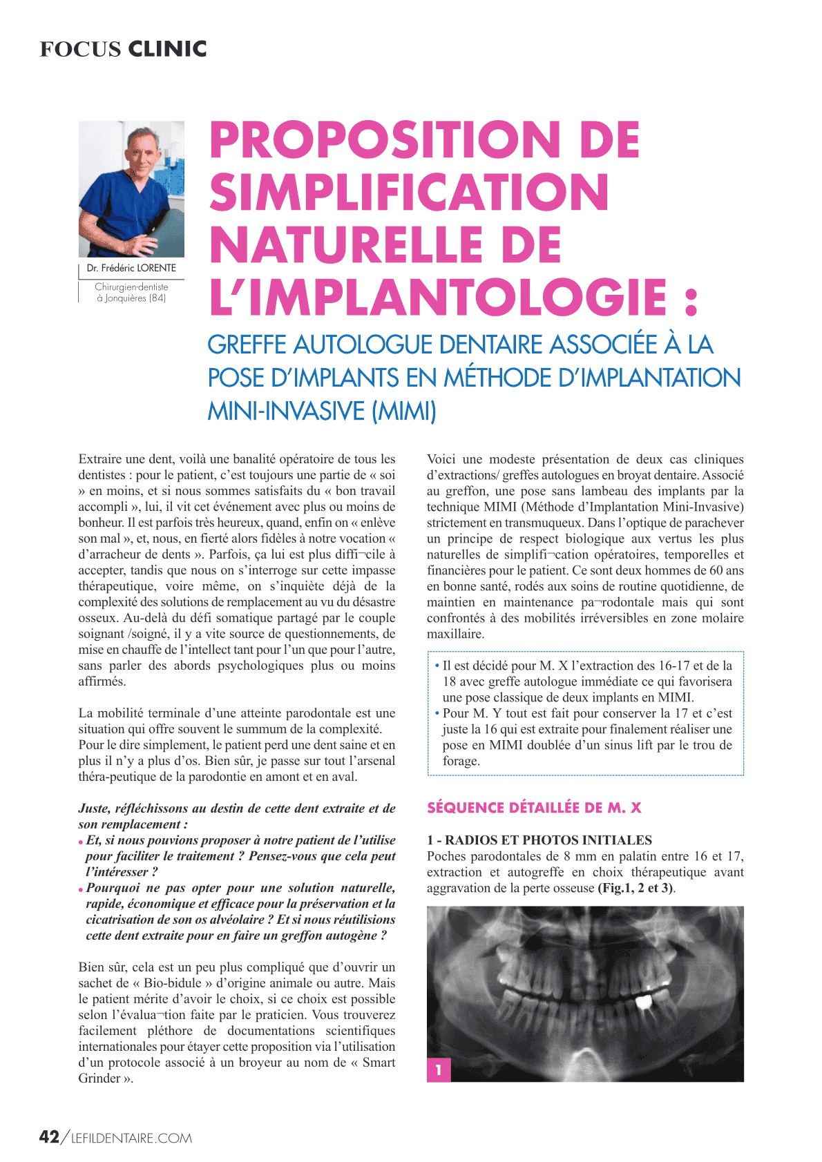 Greffe Autologue Dentaire Associée à la pose d’Implants en Méthode d’Implantation Mini-Invasive (MIMI)