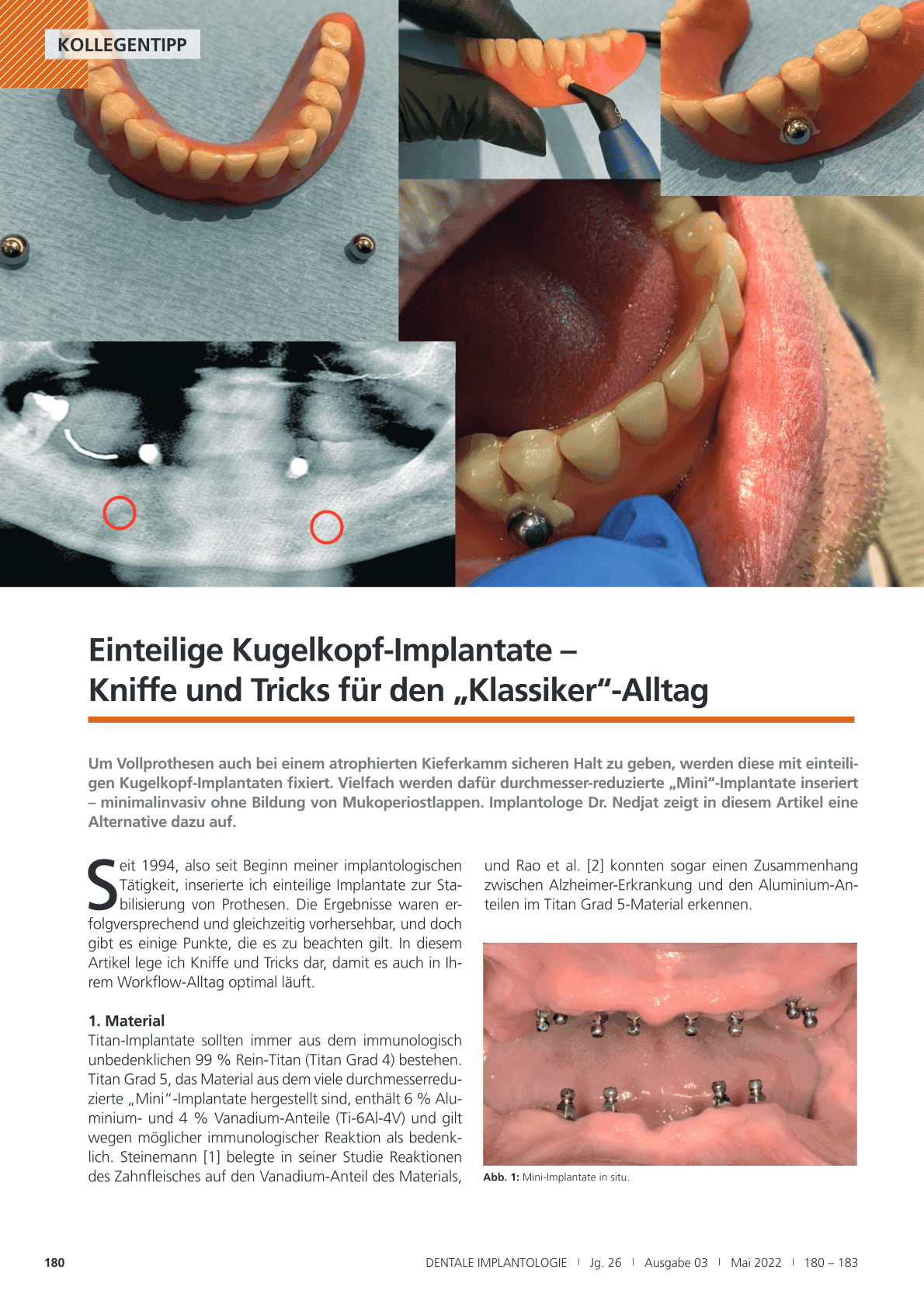 Einteilige Kugelkopf-Implantate –
Kniffe und Tricks für den „Klassiker“-Alltag