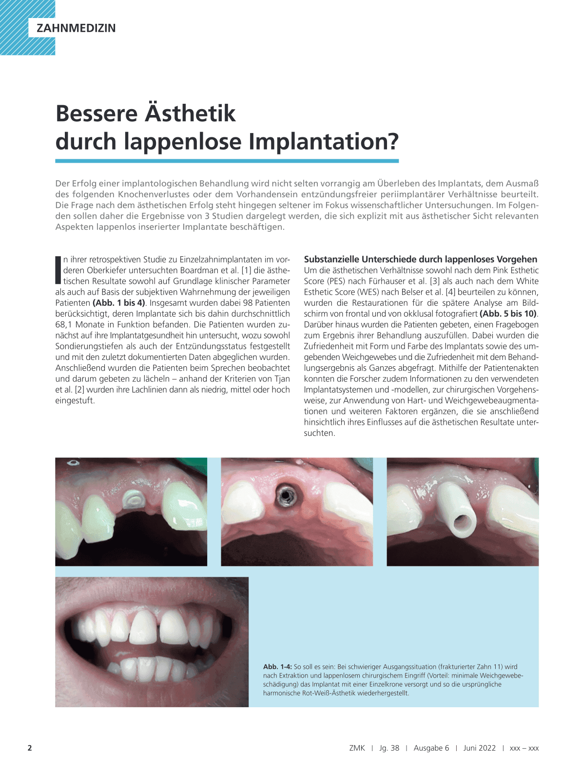 Bessere Ästhetik
durch lappenlose Implantation?