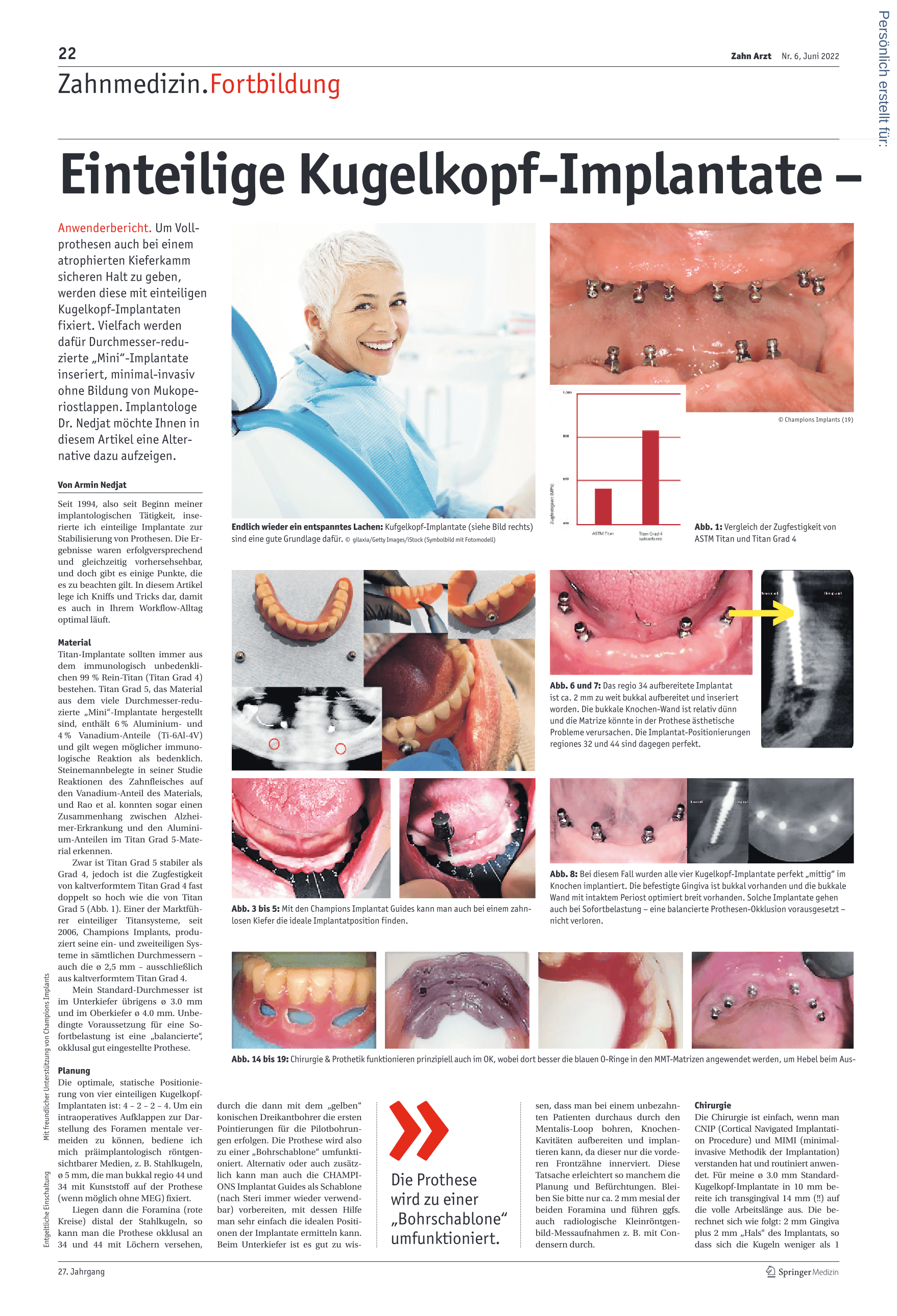 Einteilige Kugelkopf-Implantate – Kniffs & Tricks
