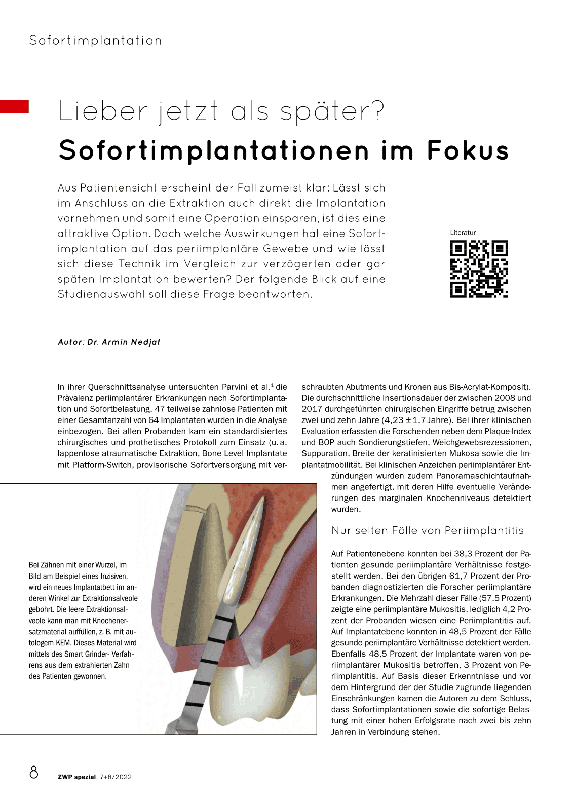 Lieber jetzt als später?
Sofortimplantationen im Fokus