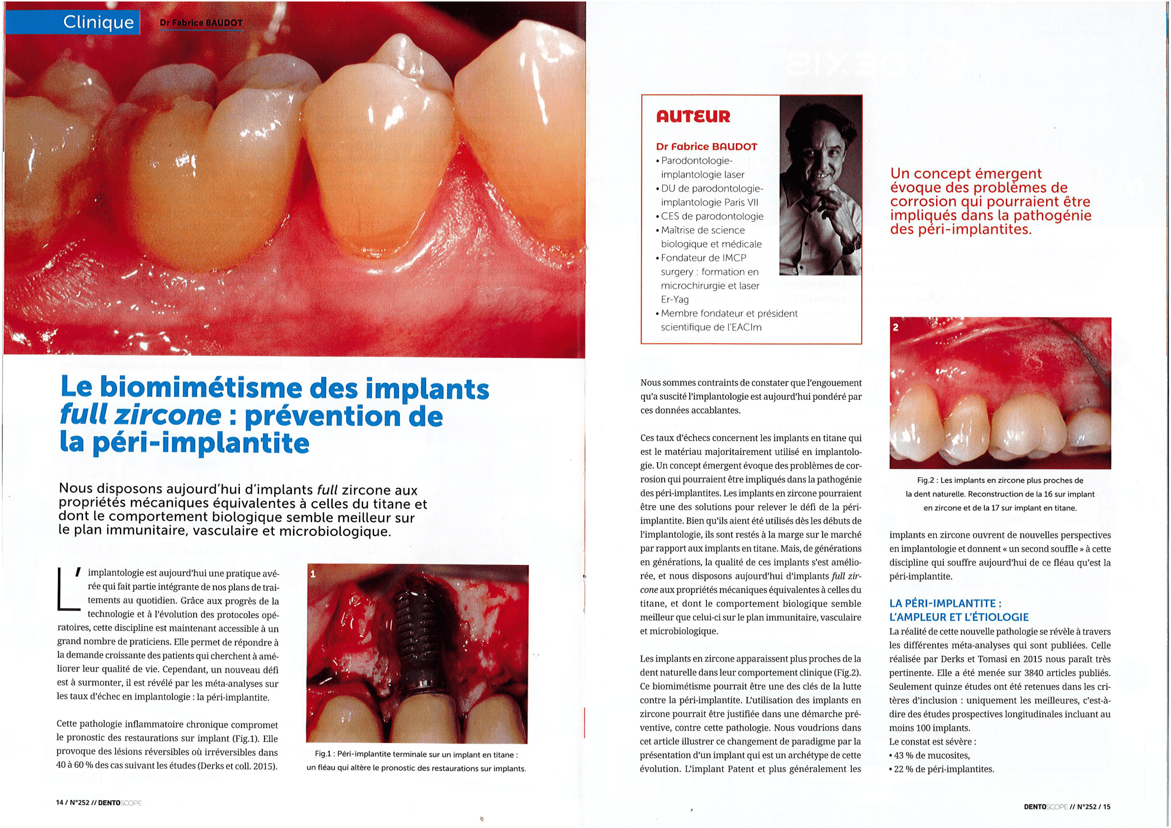 Le biomimétisme des Implants Full Zircone